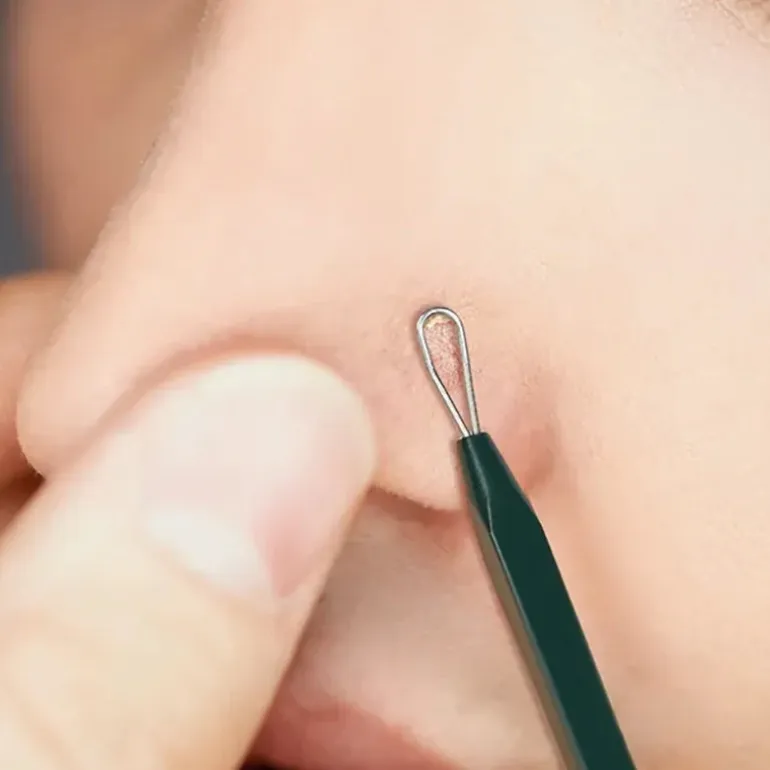 Pimple Extractor Set